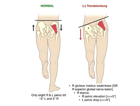 Trendelenburg Gait - Chiropractic Scientists | 915-850-0900