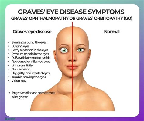 Graves Disease And Pretibial Myxedema - vrogue.co