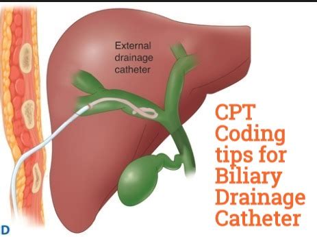 Coding guide for Biliary drainage catheter & Stent placement - Medical ...