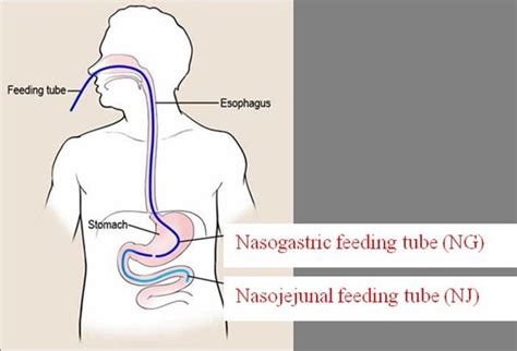 What is Enteral Nutrition? | PINNT