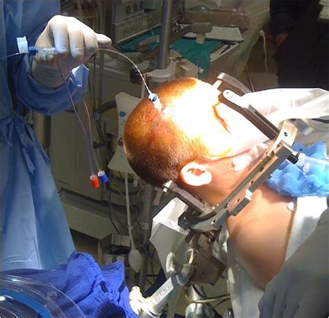 Laser Surgery for Epilepsy Less Invasive, More Precise in Early Reports - EpilepsyU