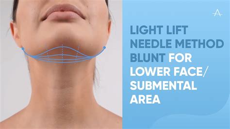 Light lift NEEDLE METHOD Blunt for lower face/submental area - YouTube