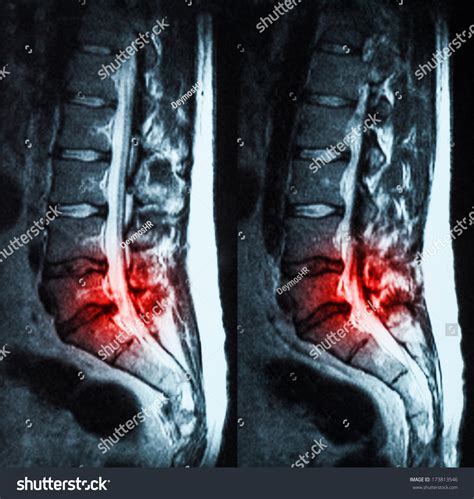 Magnetic Resonance Imaging (Mri) Of Lumbo-Sacral Spines Demonstrating Herniated Disc At L3-L4 ...