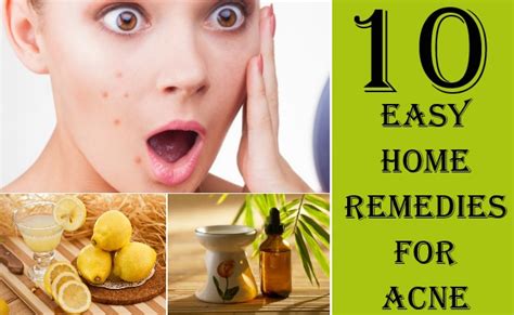 10 Surprisingly Easy Home Remedies For Acne That Actually Work | Find Home Remedy & Supplements