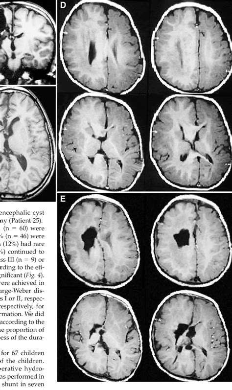 Parasagittal Meningioma | Semantic Scholar