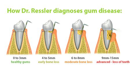 Pros and Cons of laser gum surgery vs traditional gum disease treatmnent