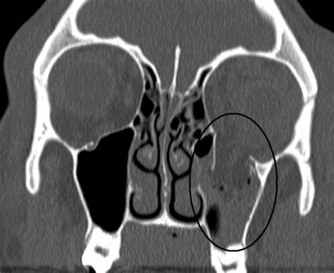 Enophthalmos - almostadoctor