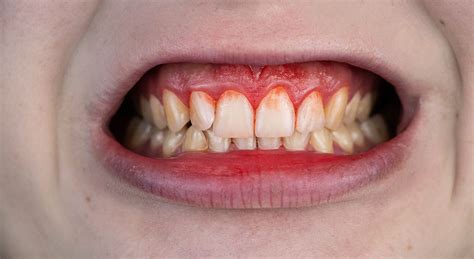 How to Prevent Gum Disease from Getting Worse - Smile Glen Ellyn Restorative Dentist