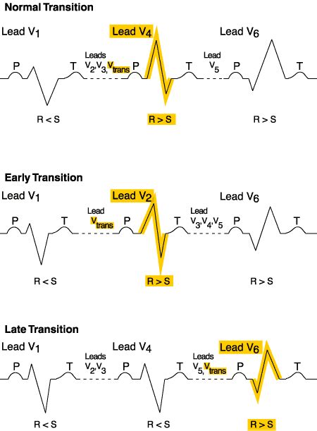 “R” is for qRs Analysis | Early R-Wave Transition & Abnormal R-wave ...