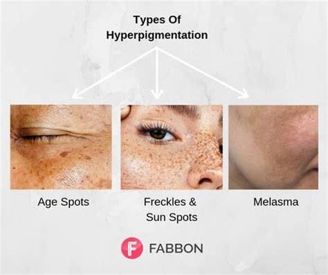 Hyperpigmentation Guide: Treatments, Types, Causes And Preventions | Fabbon