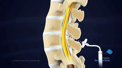 Lumbar Puncture Video | Medical Video Library