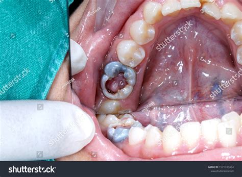 Closeup Pulp Polyp Gingiva Tooth Stock Photo 1571330434 | Shutterstock