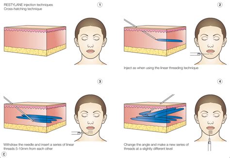 Hyaluronic Acid Filler Injection | Ento Key