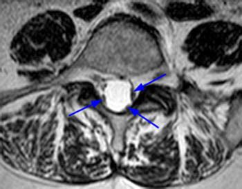 Arachnoiditis | Radsource