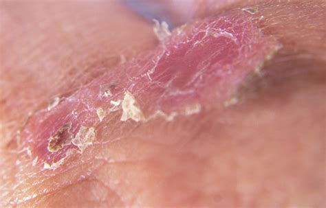 Macro Image Shows Second Degree Burn Wound Healing Stock Photo - Download Image Now - iStock