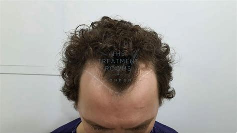 How Much Does A Widow's Peak Hair Transplant Cost? - Hair Transplant Specialists - Treatment ...