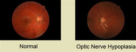 Lune AA, Lune SA. Septo-optic dysplasia with pachygyria. Med J DY Patil ...