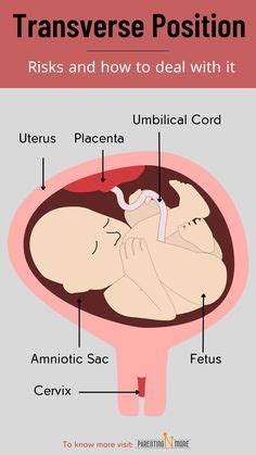 Understanding Right Occiput Anterior – ROA fetal position + FAQs