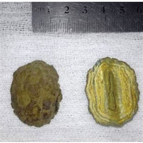 (a) X-ray abdomen (lateral) demonstrating the enterolith with multiple... | Download Scientific ...