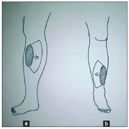 (PDF) The keystone-design perforator-based flap for leg defects: a ...