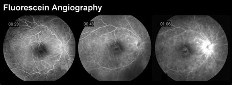 Fluorescein Angiography – Win Retina