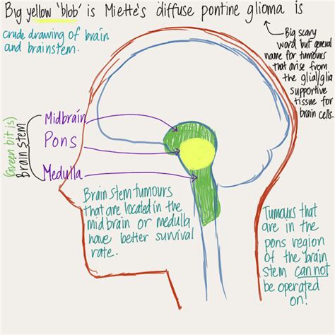 Glioma: Diffuse Intrinsic Pontine Glioma Survival Rate