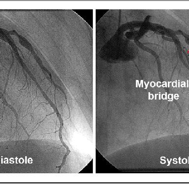 Representative case of myocardial bridge. Left: coronary angiography ...