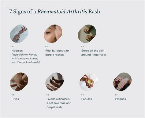 What Does A Rheumatoid Arthritis Rash Look Like? 7 Signs You Have RA