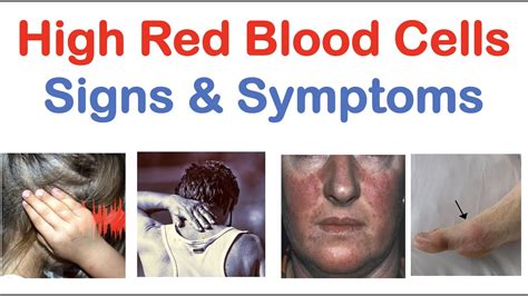 High Red Blood Cells (Polycythemia) Signs & Symptoms (& Why They Occur ...