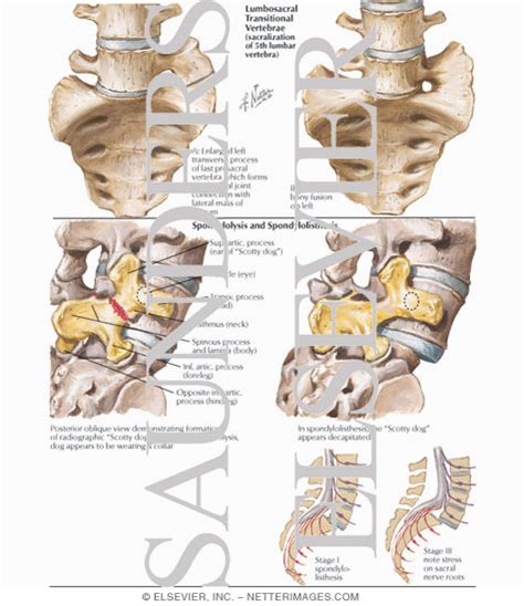 Lumbosacral Transitional Vertebrae; Spondylolysis and Spondylolisthesis