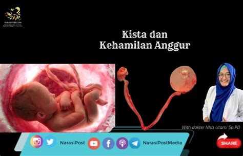 Kista dan Kehamilan Anggur - NarasiPost.Com