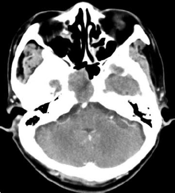 Initial brain computed tomography (CT) showing a clivus mass. | Download Scientific Diagram