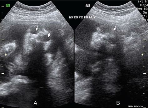 File:Anencephaly ultrasound.jpg - Embryology