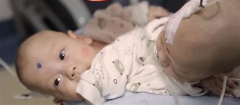 Video of conjoined twins separated