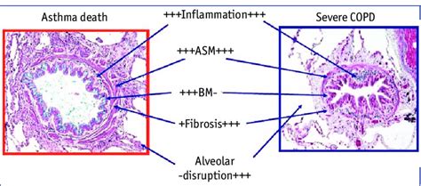 Contrasting histopathology of asthma and chronic obstructive pulmonary... | Download Scientific ...