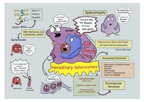 Hereditary Spherocytosis: Intrinsic Hemolysis - Creative Med Doses