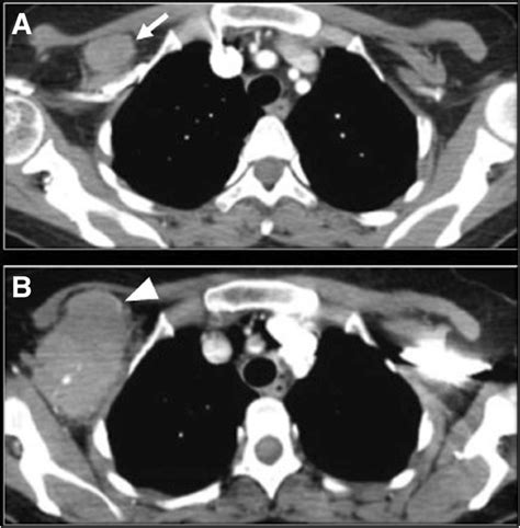 Multimodality imaging of indolent B cell lymphoma from diagnosis to transformation: what every ...