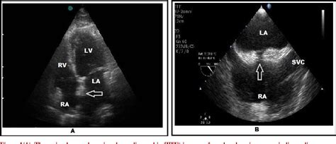 Figure 1 from Lipomatous Hypertrophy of the Interatrial Septum Accompanied By Interatrial Septal ...