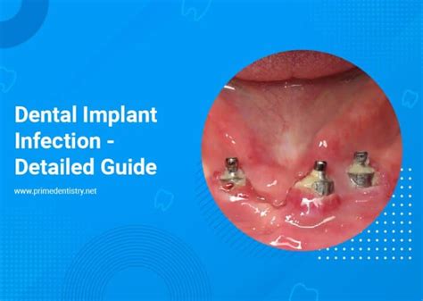 Dental Implant Infection: Causes, Symptoms, Risks, and Treatments ...