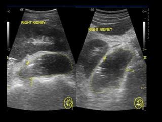 Perinephric abscess imaging