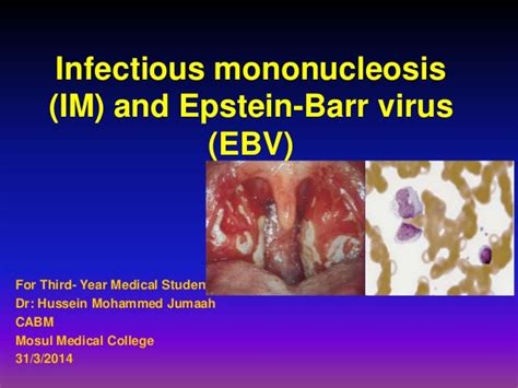 Mononucleosis - Acute Infectious Mononucleosis Pathogenesis And Clinical Findings Calgary Guide ...