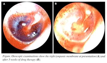 Academic OneFile - Document - Traumatic hemotympanum with facial palsy