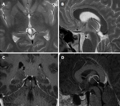 Evaluation of pineal cysts with magnetic resonance imaging