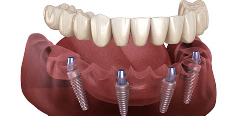 Implant failure: Symptoms, Causes, Treatments - Clínica Blasi