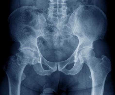 List 101+ Pictures What Does Hip Arthritis Look Like On X Ray Sharp
