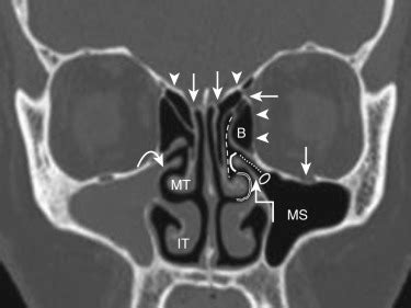 Paranasal Sinuses | Radiology Key