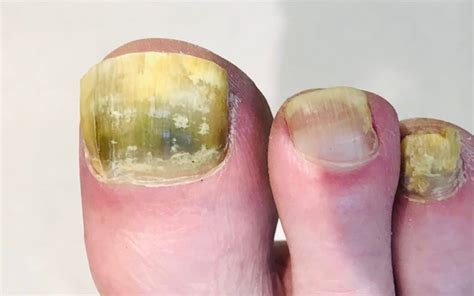 Fungal Nails Archives | A Step Ahead Foot + Ankle Care