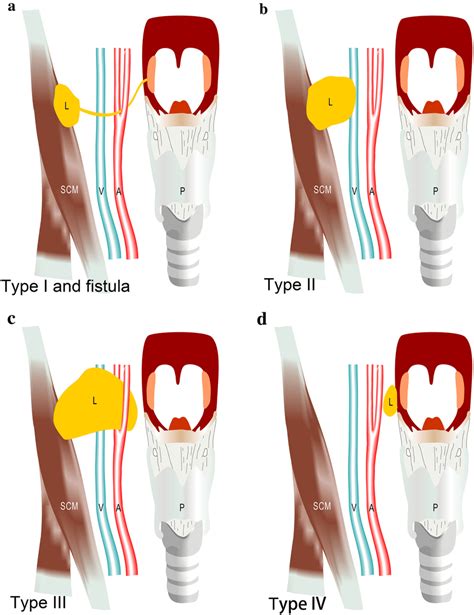 Four types of the second branchial cleft cysts classified by Bailey and ...