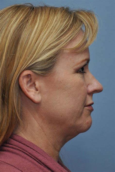 Lower Facelift/Neck Lift Patient 3