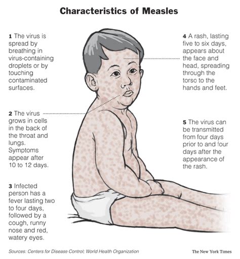 Free For Health: Measles - Causes-Symptoms and Treatment